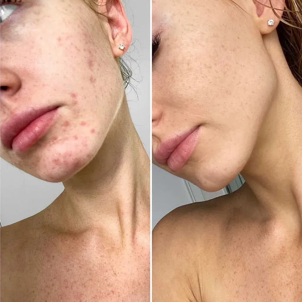 Alpha-H-acne_1024x1024.webp